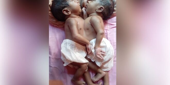 জোড়া লাগানো যমজ শিশুর পরিবার আর্থিক সংকটে, অনিশ্চিত আলাদা হওয়ার চিকিৎসা